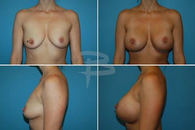 Breast Augmentation Before & After Gallery - Patient 192277043 - Image 1