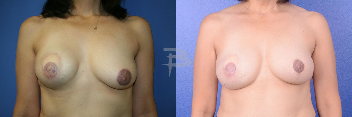 Breast Flap Reconstruction Before & After Gallery - Patient 192277044 - Image 1