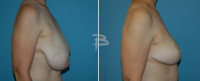 Breast Reduction Before & After Gallery - Patient 192277045 - Image 1