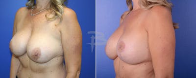 Breast Implant Reconstruction Before & After Gallery - Patient 192277047 - Image 1