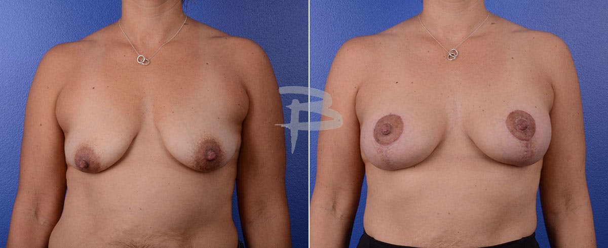 Breast Lift Before & After Gallery - Patient 192277046 - Image 1