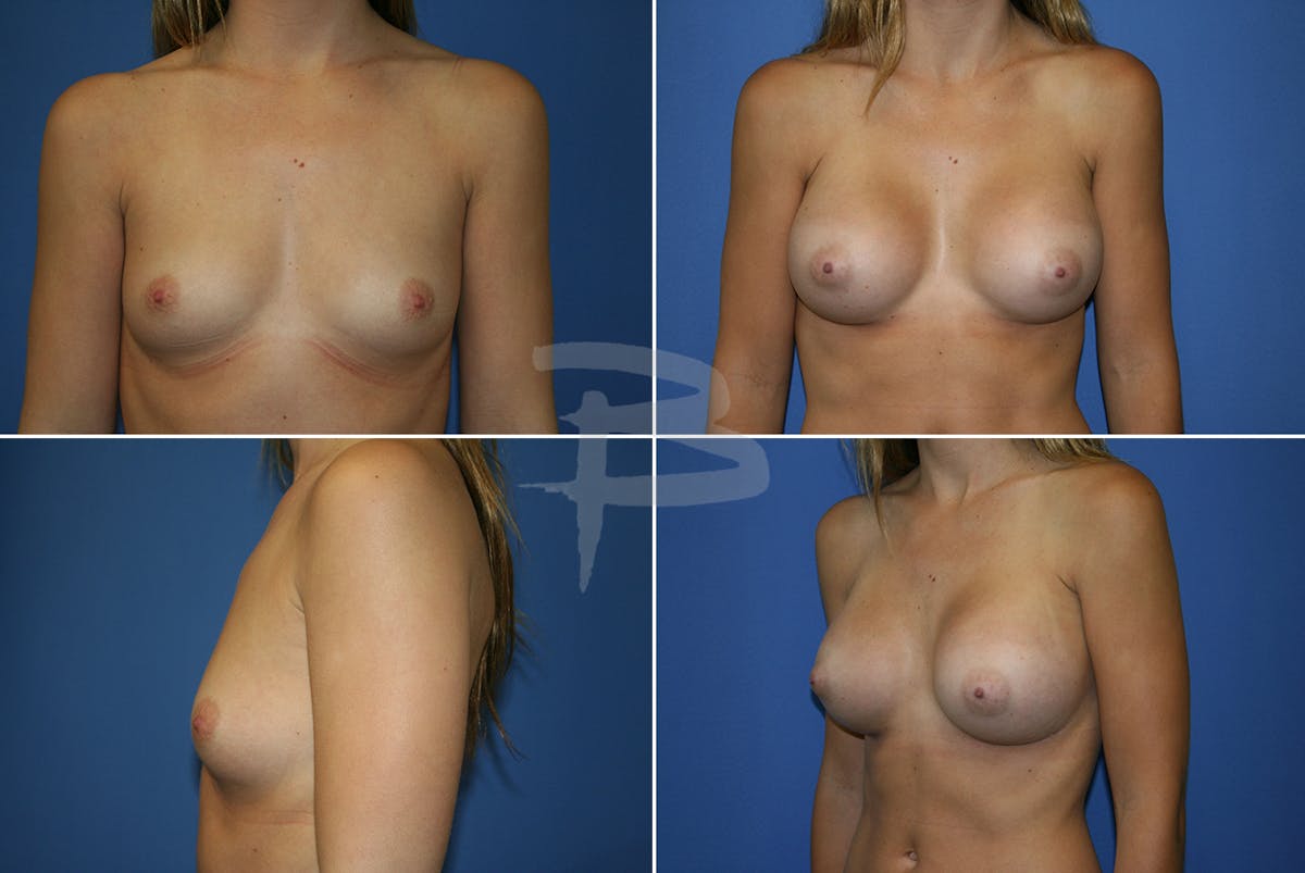 Breast Augmentation Before & After Gallery - Patient 192277057 - Image 1