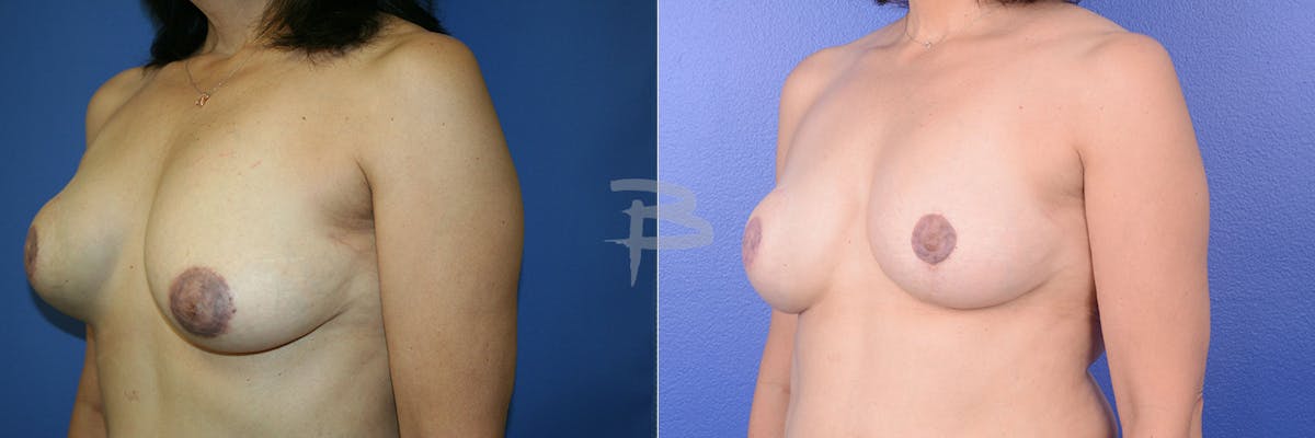 Breast Flap Reconstruction Before & After Gallery - Patient 192277048 - Image 1