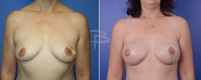 Breast Implant Reconstruction Before & After Gallery - Patient 192277059 - Image 1