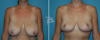 Breast Reduction Before & After Gallery - Patient 192277050 - Image 1