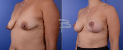 Breast Lift Before & After Gallery - Patient 192277049 - Image 1