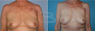 Breast Flap Reconstruction Before & After Gallery - Patient 192277060 - Image 1