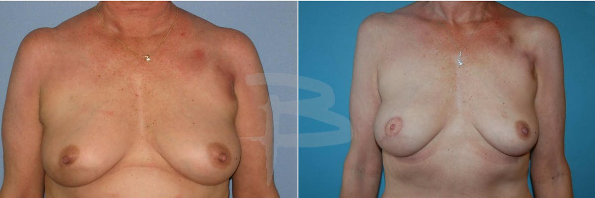 Breast Flap Reconstruction Before & After Gallery - Patient 192277060 - Image 1
