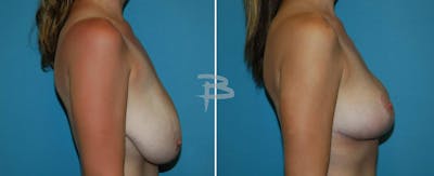 Breast Reduction Before & After Gallery - Patient 192277062 - Image 1