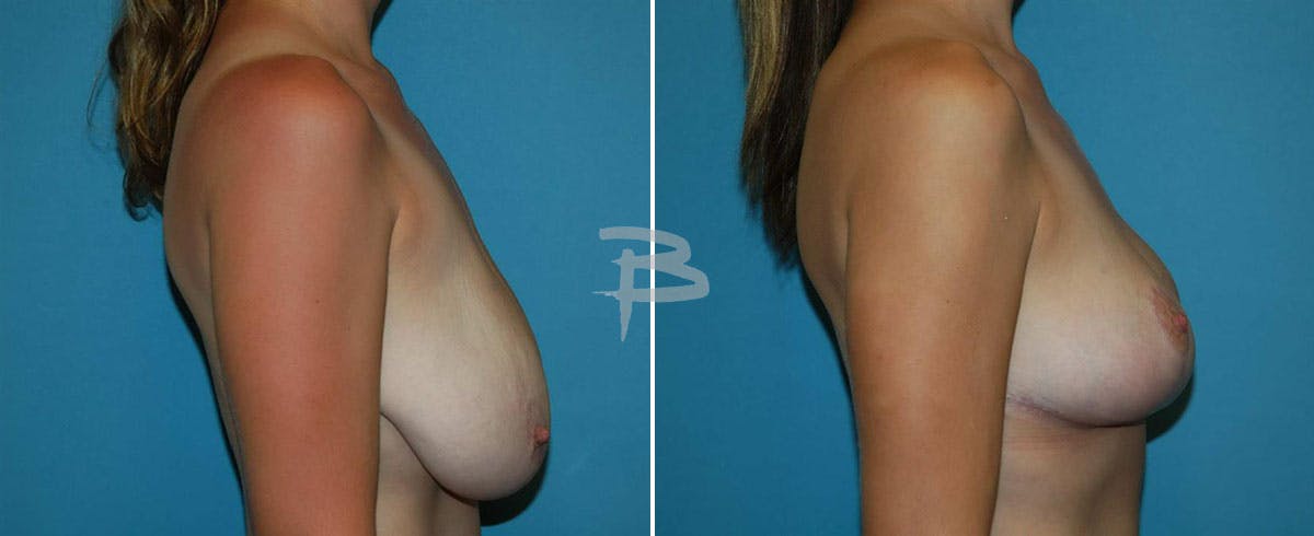 Breast Reduction Before & After Gallery - Patient 192277062 - Image 1
