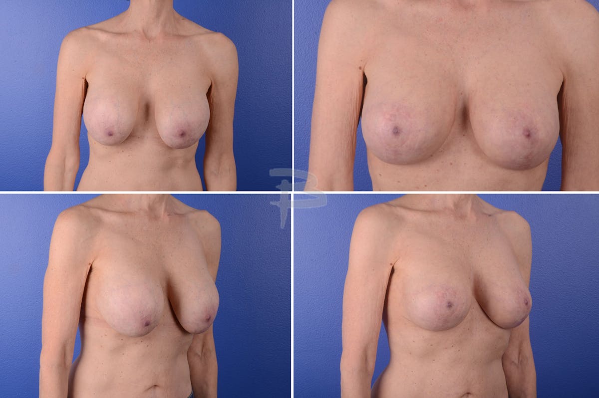 Revisionary Breast Surgery Before & After Gallery - Patient 192277067 - Image 1