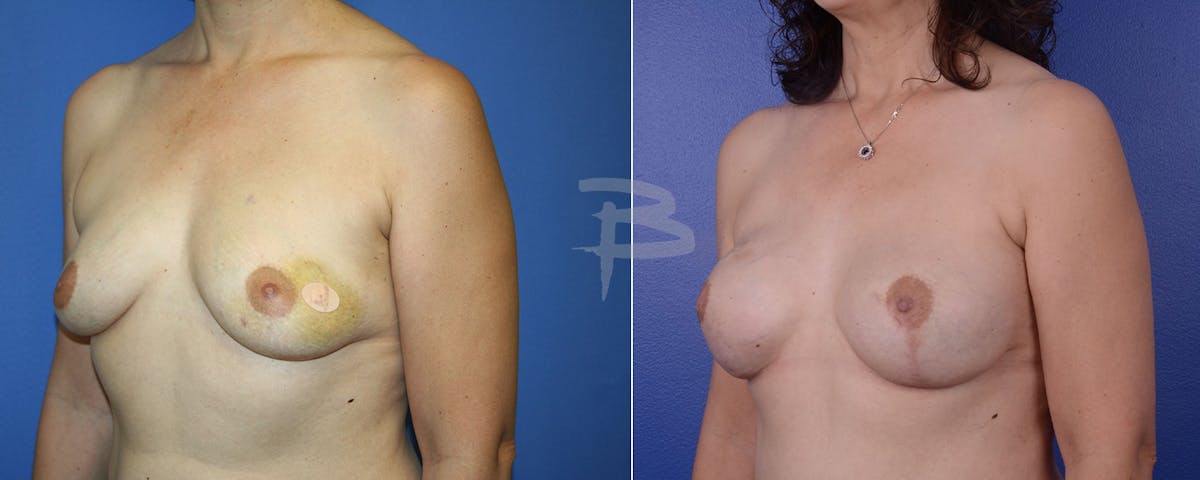 Breast Implant Reconstruction Before & After Gallery - Patient 192277063 - Image 1