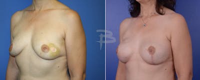 Breast Implant Reconstruction Before & After Gallery - Patient 192277063 - Image 1