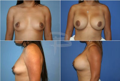 Breast Augmentation Before & After Gallery - Patient 192277068 - Image 1