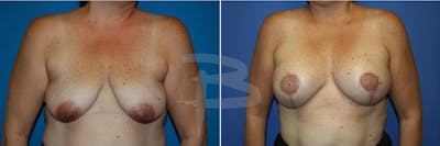 Breast Flap Reconstruction Before & After Gallery - Patient 192277064 - Image 1