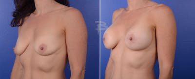 Breast Lift Before & After Gallery - Patient 192277066 - Image 1