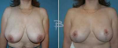 Breast Reduction Before & After Gallery - Patient 192277069 - Image 1