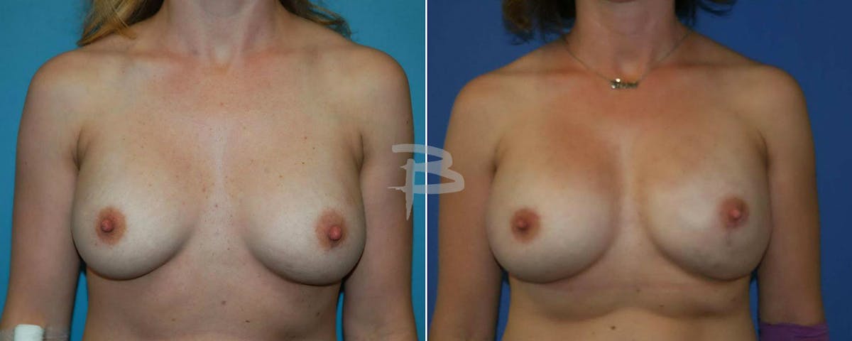 Breast Implant Reconstruction Before & After Gallery - Patient 192277070 - Image 1