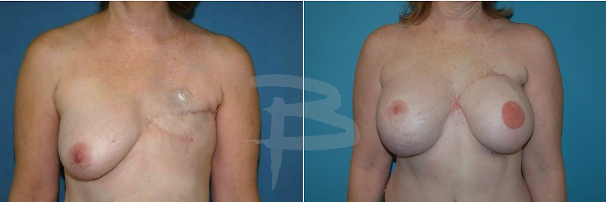 Breast Flap Reconstruction Before & After Gallery - Patient 192277072 - Image 1