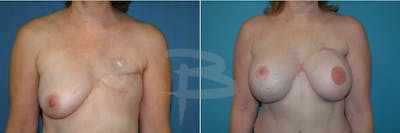 Breast Flap Reconstruction Before & After Gallery - Patient 192277072 - Image 1