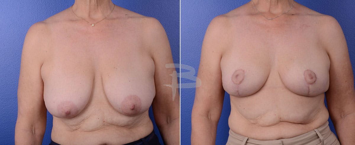 Breast Lift Before & After Gallery - Patient 192277071 - Image 1