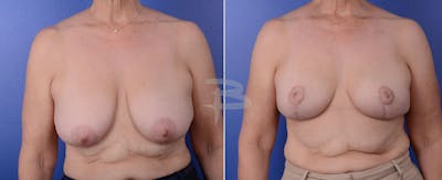 Breast Lift Before & After Gallery - Patient 192277071 - Image 1