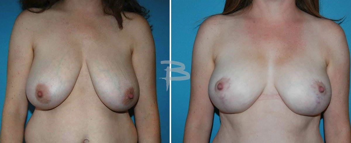 Breast Reduction Before & After Gallery - Patient 192277073 - Image 1