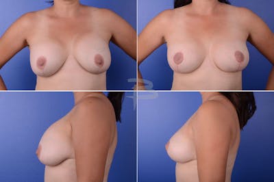 Revisionary Breast Surgery Before & After Gallery - Patient 192277075 - Image 1