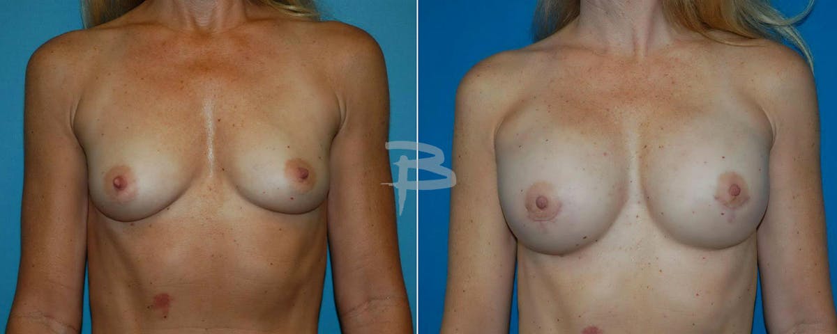Breast Implant Reconstruction Before & After Gallery - Patient 192277074 - Image 1