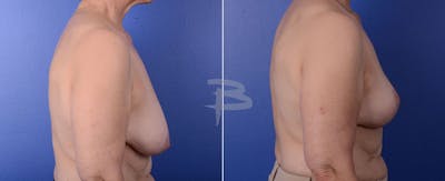 Breast Lift Before & After Gallery - Patient 192277078 - Image 1