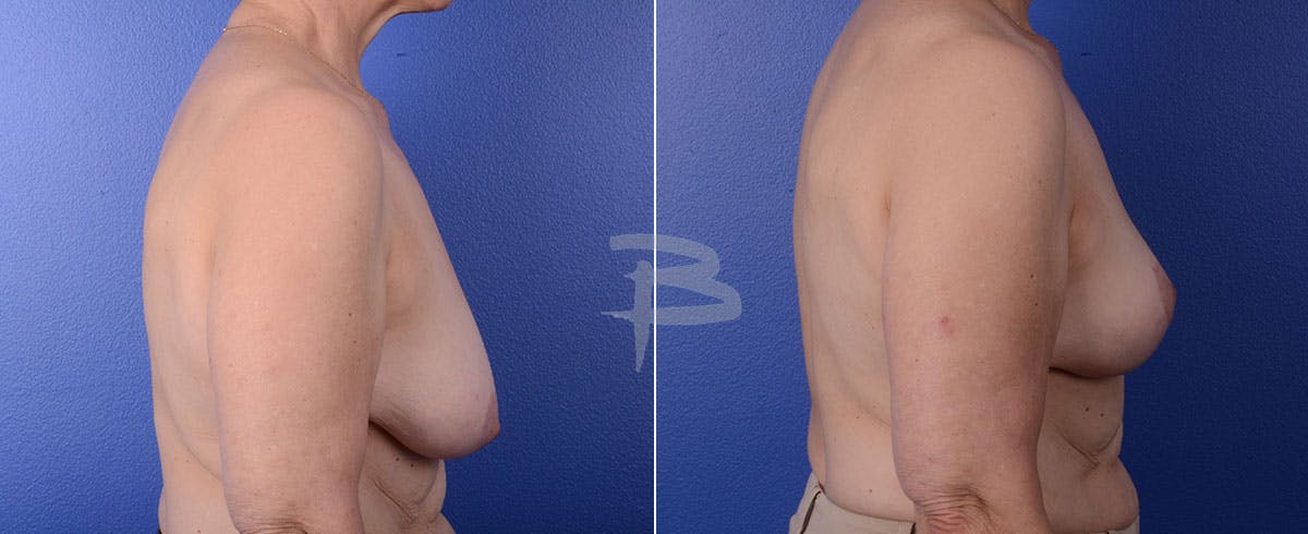 Breast Lift Before & After Gallery - Patient 192277078 - Image 1