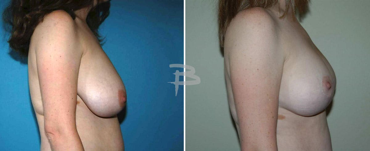Breast Reduction Before & After Gallery - Patient 192277079 - Image 1