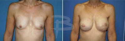 Breast Flap Reconstruction Before & After Gallery - Patient 192277077 - Image 1