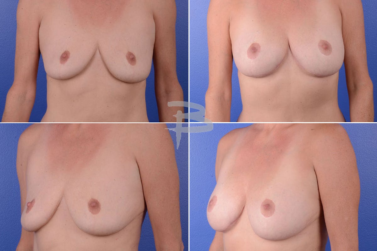 Revisionary Breast Surgery Before & After Gallery - Patient 192277082 - Image 1