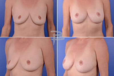 Revisionary Breast Surgery Before & After Gallery - Patient 192277082 - Image 1