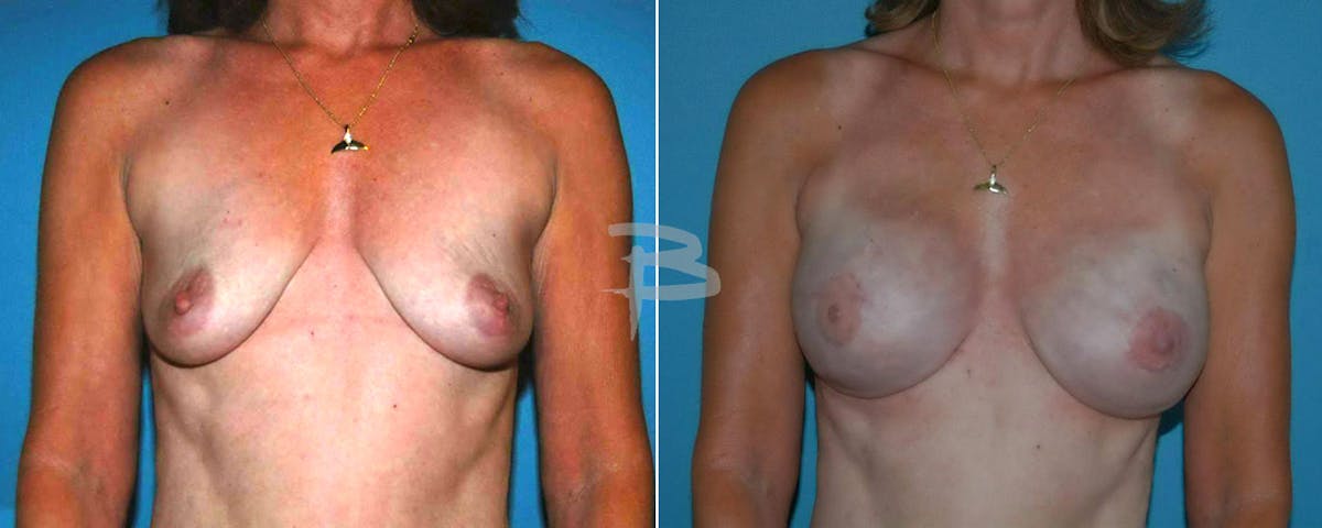Breast Implant Reconstruction Before & After Gallery - Patient 192277080 - Image 1