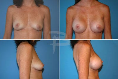 Breast Augmentation Before & After Gallery - Patient 192277084 - Image 1
