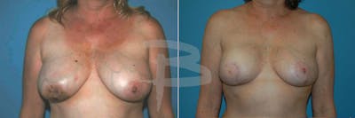 Breast Flap Reconstruction Before & After Gallery - Patient 192277086 - Image 1
