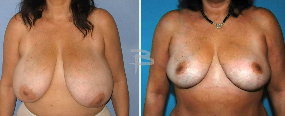 Breast Reduction Before & After Gallery - Patient 192277085 - Image 1