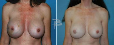 Breast Implant Reconstruction Before & After Gallery - Patient 192277088 - Image 1