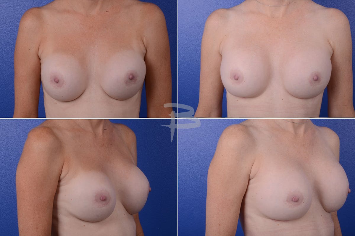 Revisionary Breast Surgery Before & After Gallery - Patient 192277089 - Image 1
