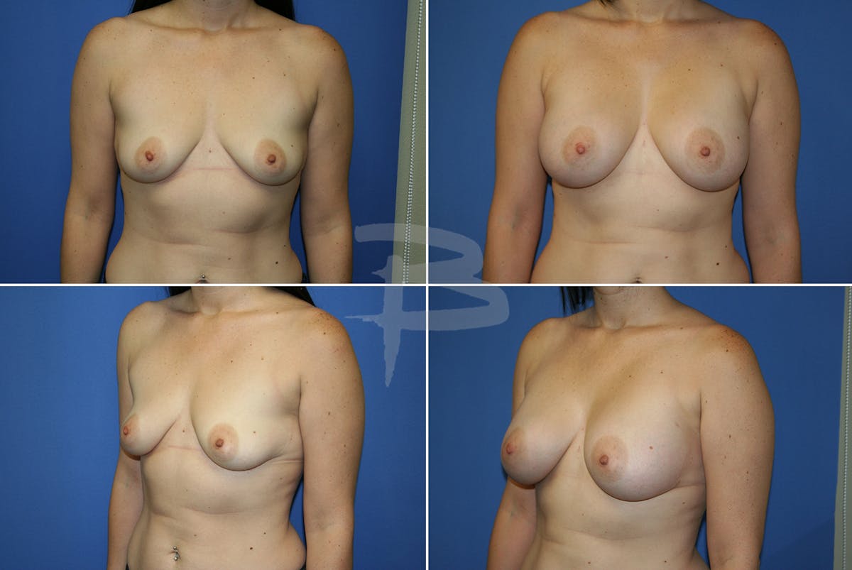 Breast Augmentation Before & After Gallery - Patient 192277094 - Image 1