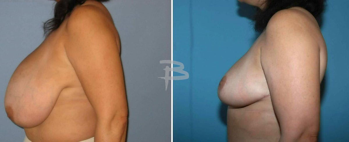 Breast Reduction Before & After Gallery - Patient 192277090 - Image 1