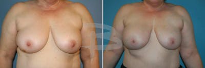 Breast Flap Reconstruction Before & After Gallery - Patient 192277091 - Image 1