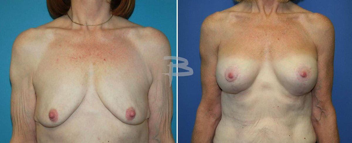 Breast Lift Before & After Gallery - Patient 192277092 - Image 1