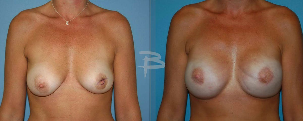 Breast Implant Reconstruction Before & After Gallery - Patient 192277093 - Image 1