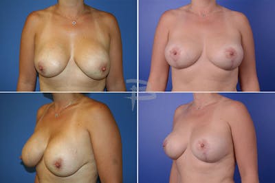 Revisionary Breast Surgery Before & After Gallery - Patient 192277095 - Image 1