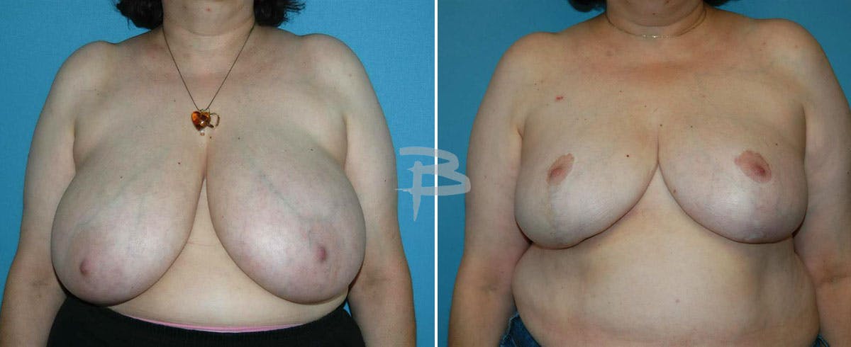 Breast Reduction Before & After Gallery - Patient 192277097 - Image 1