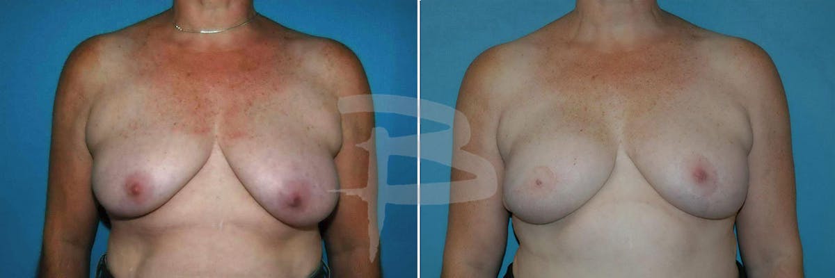 Breast Flap Reconstruction Before & After Gallery - Patient 192277098 - Image 1
