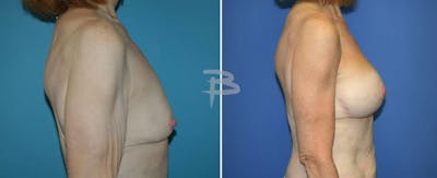 Breast Lift Before & After Gallery - Patient 192277096 - Image 1